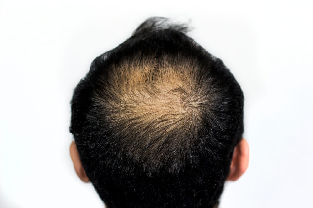 Male-baldness