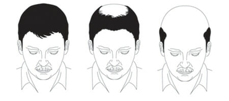 identifying_male_baldness