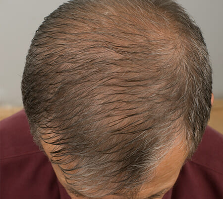 Hair Loss In Men | Boss Clinic
