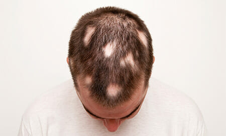 Hair Loss In Men | Boss Clinic