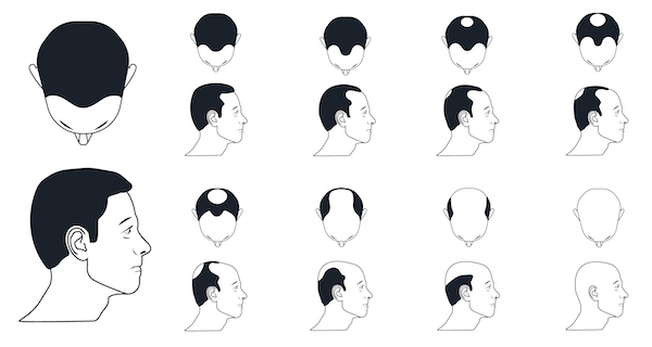 types of male baldness, norwood scale icons