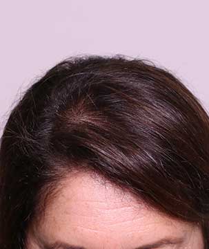 Hair Loss Clinic Perth | Hair Loss Treatments & Solutions – Boss Clinic