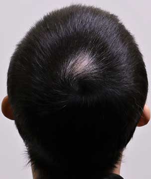 Hair Loss Clinic Perth | Hair Loss Treatments & Solutions – Boss Clinic