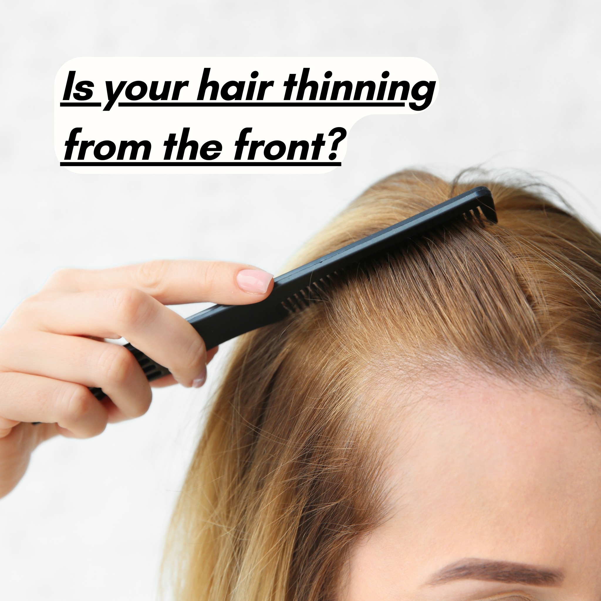 Thinning front hair women