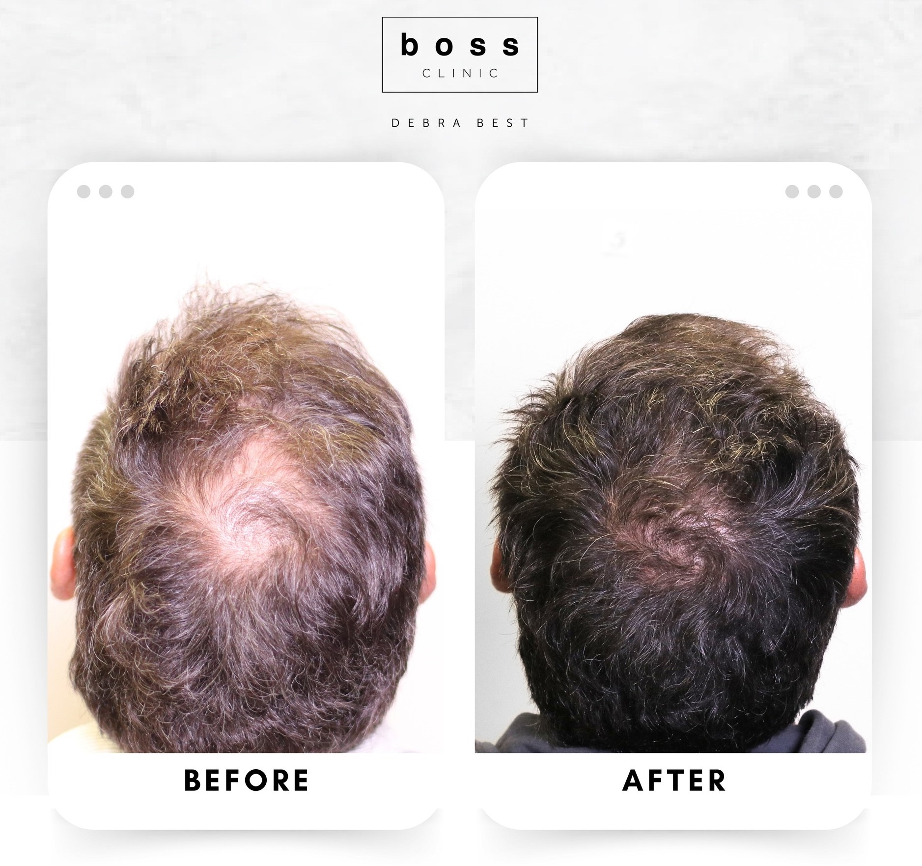 Mens Hair Regrowth 01