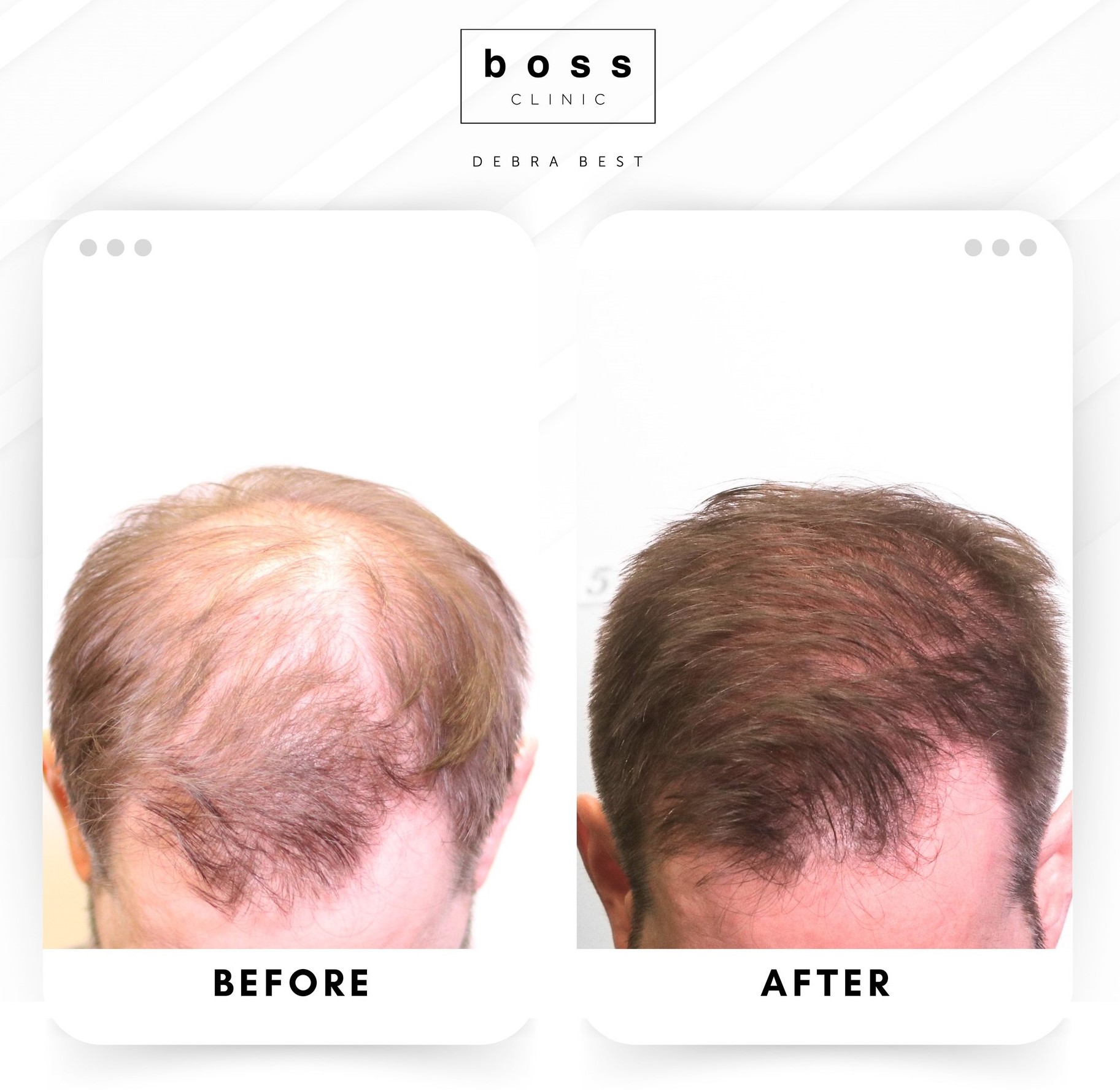 Mens Hair Regrowth 02