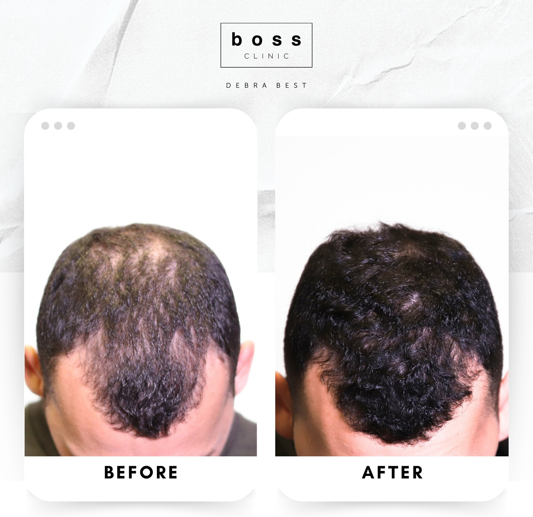 Mens Hair Regrowth 03