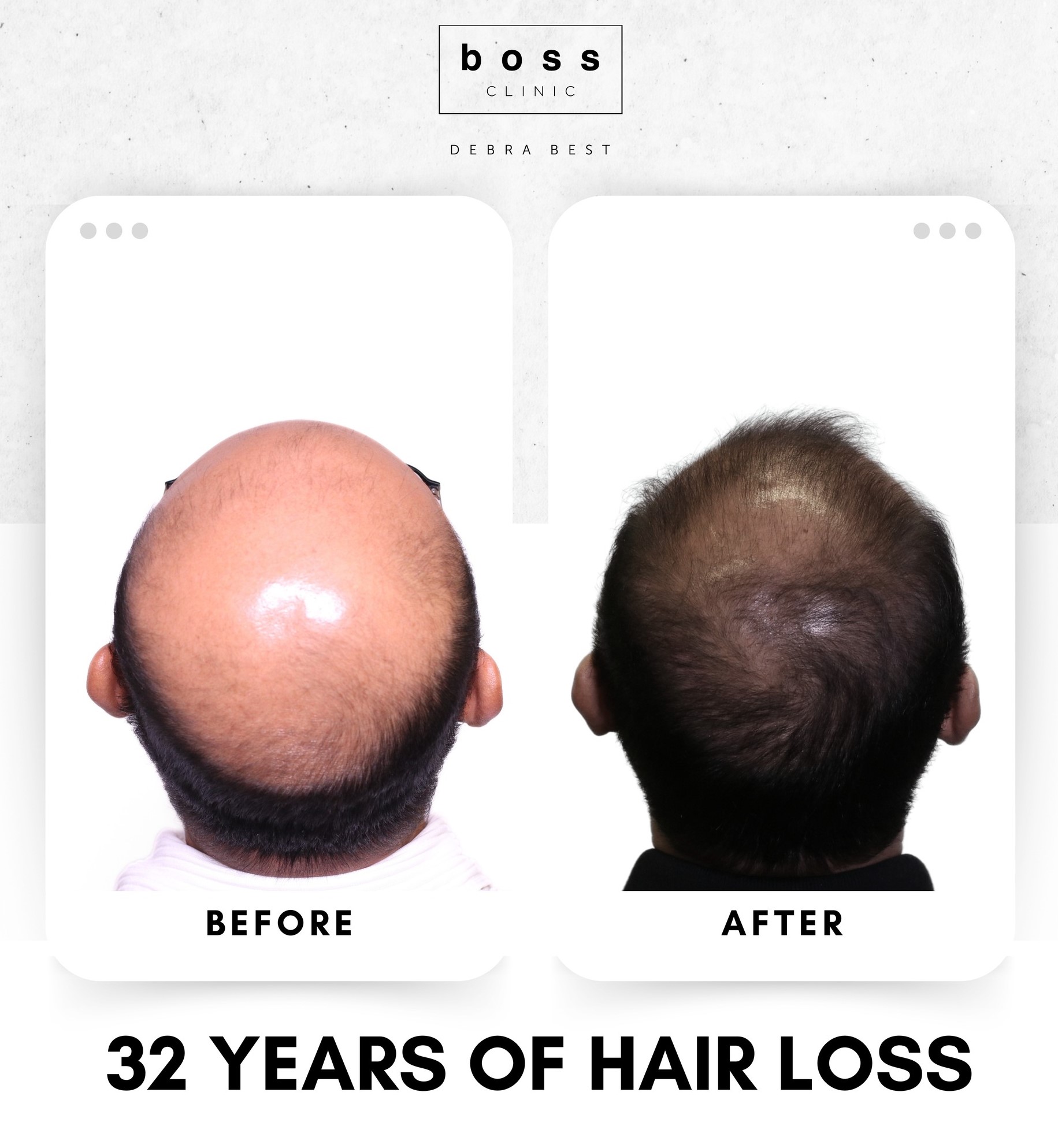 Mens Hair Regrowth 04