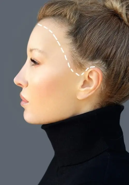 Alopecia Areata for female pattern baldness