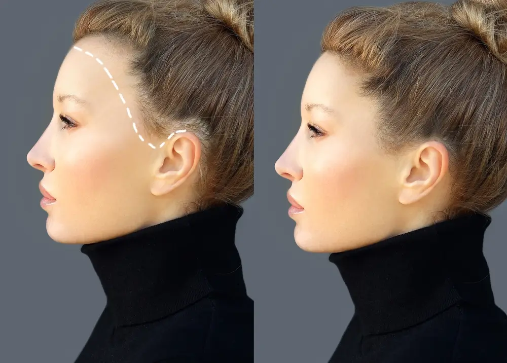 Alopecia Areata for female pattern baldness