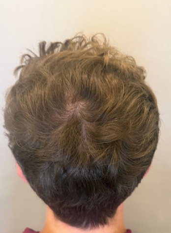 Male back of head after three months of hair loss treatment at Boss Clinic Bondi