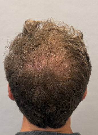 Male back of head before hair loss treatment at Boss Clinic Bondi