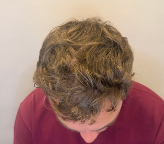 Male crown after three months of hair loss treatment at Boss Clinic Bondi