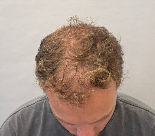 Male crown before hair loss treatment at Boss Clinic Bondi
