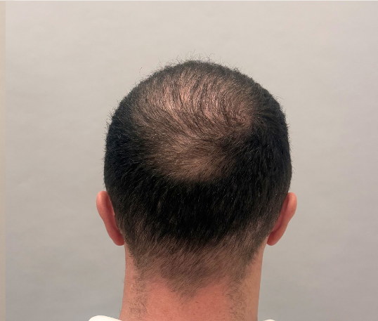 Male back of head after three months of hair loss treatment at Boss Clinic Bondi