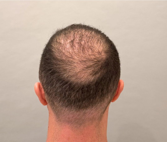 Male back of head before hair loss treatment at Boss Clinic Bondi