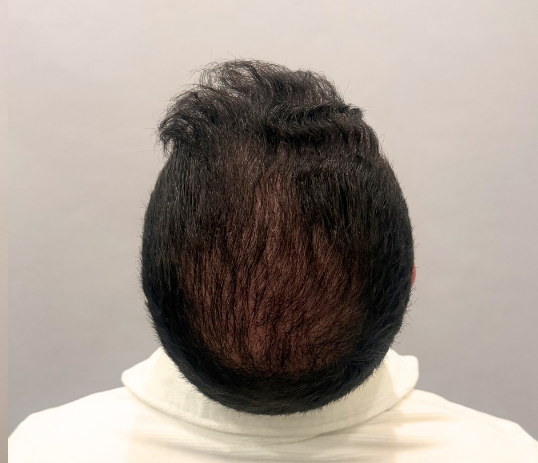 Male crown after three months of hair loss treatment at Boss Clinic Bondi