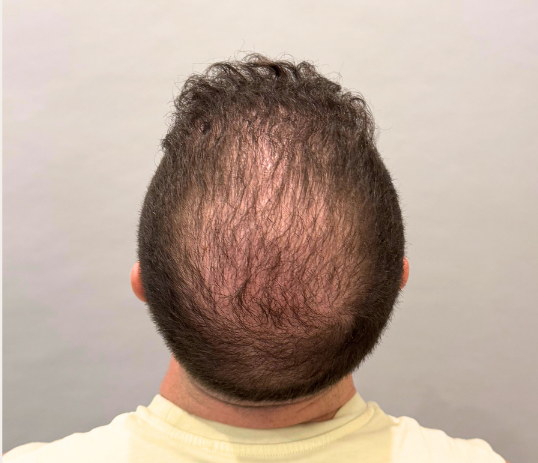 Male crown before hair loss treatment at Boss Clinic Bondi