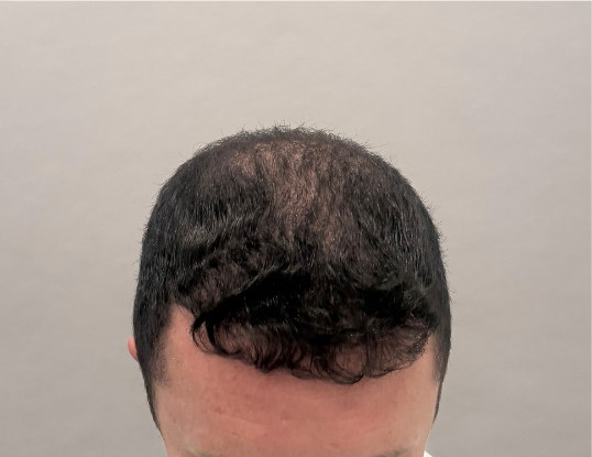 Male hairline after three months of hair loss treatment at Boss Clinic Bondi