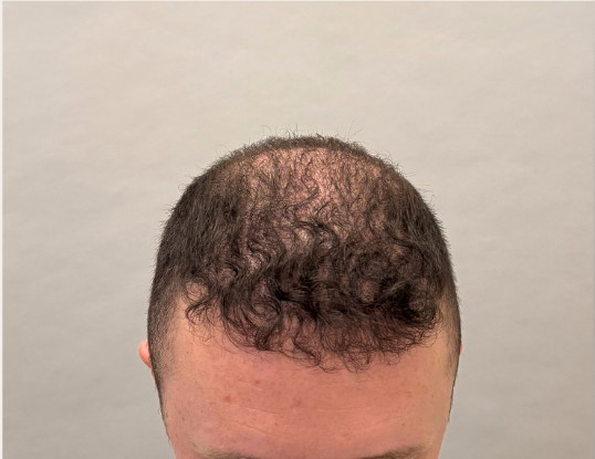 Male hairline before hair loss treatment at Boss Clinic Bondi