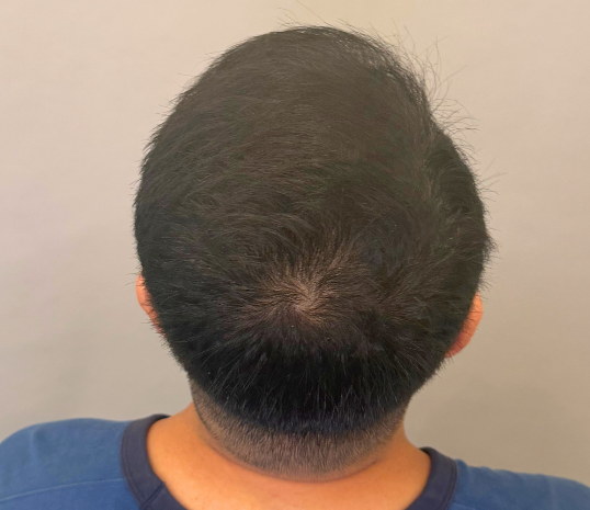 Male back of head after three months of hair loss treatment at Boss Clinic Bondi