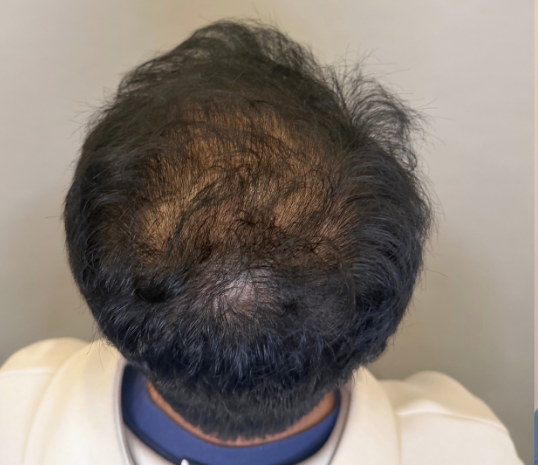 Male back of head before hair loss treatment at Boss Clinic Bondi