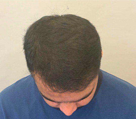 Male crown after three months of hair loss treatment at Boss Clinic Bondi
