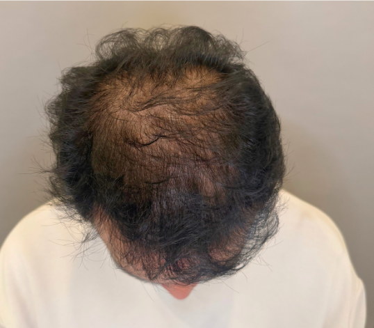 Male crown before hair loss treatment at Boss Clinic Bondi