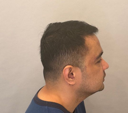 Male side profile after three months of hair loss treatment at Boss Clinic Bondi