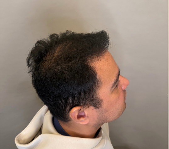 Male side profile before hair loss treatment at Boss Clinic Bondi